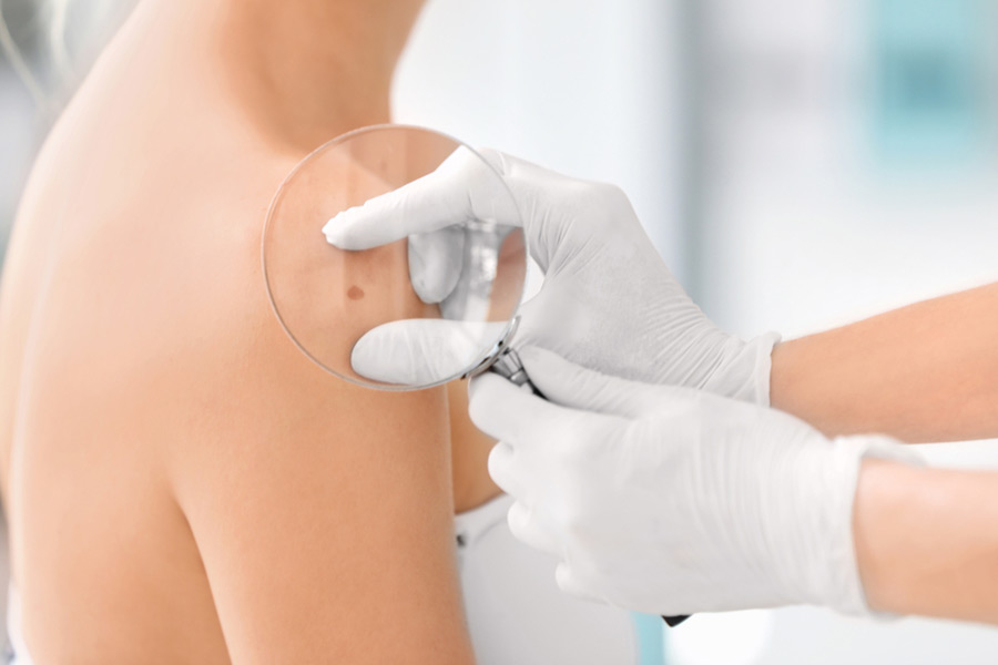Algunas Formas de Prevenir el Cáncer de Piel